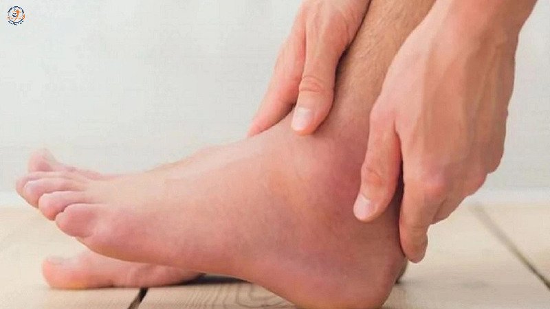 Bong gân là tình trạng dây chằng giãn quá mức