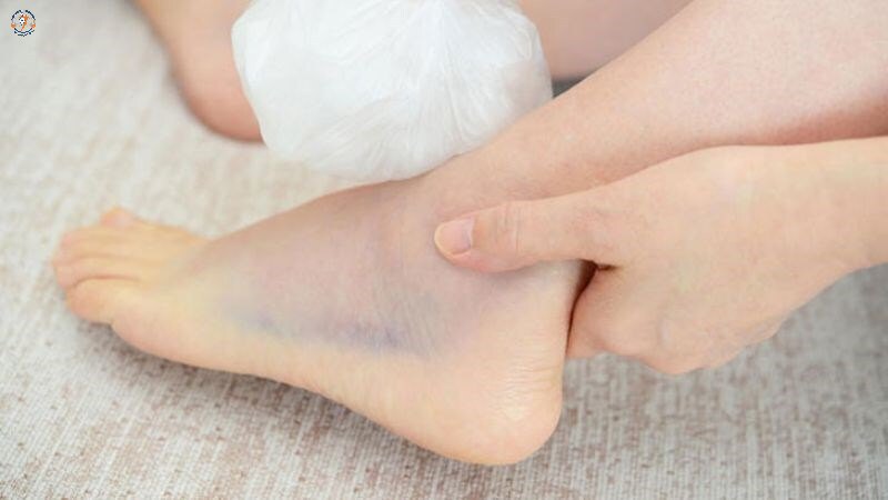 Bong gân có thể hiểu là dây chằng bị kéo giãn