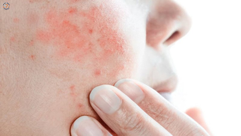 Dấu hiệu cảnh báo hội chứng Steven Johnson