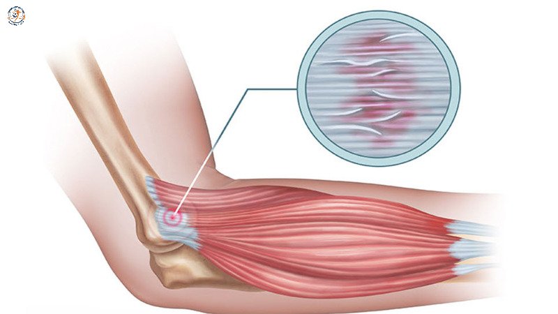 Dây chằng khuỷu tay