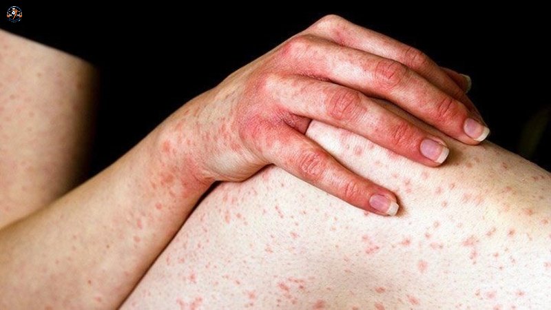 Đối tượng có nguy cơ mắc Steven Johnson