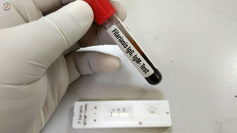 Thời điểm nên xét nghiệm chỉ số IG trong máu