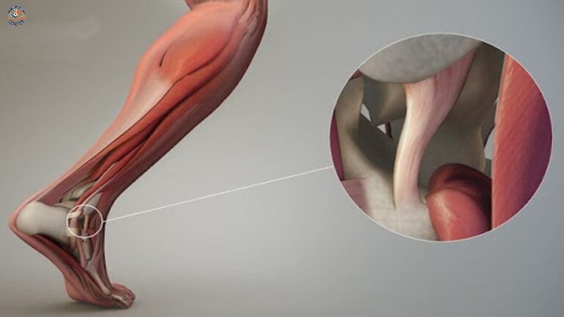 Nguyên nhân khiến dây chằng hay bị tổn thương