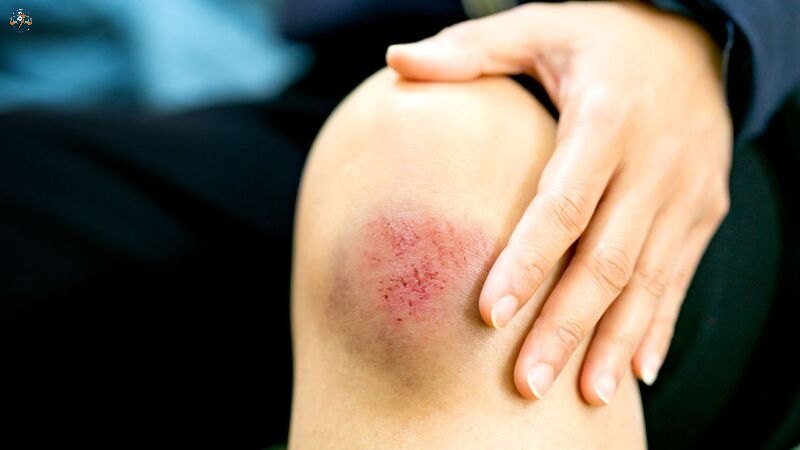 Nguyên nhân gây ra các chấn thương mô mềm