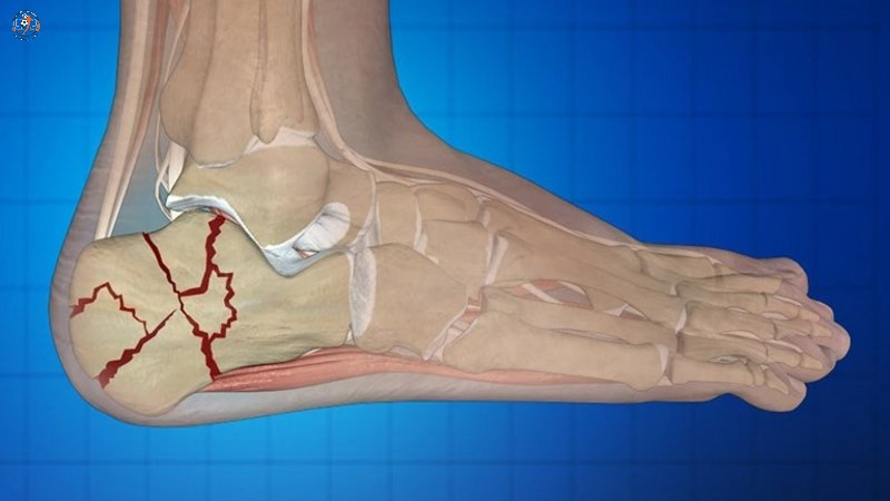 Có nhiều nguyên nhân dẫn đến gãy gót chân