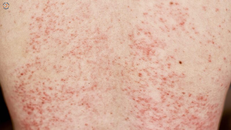 Steven Johnson là bệnh dị ứng da nghiêm trọng