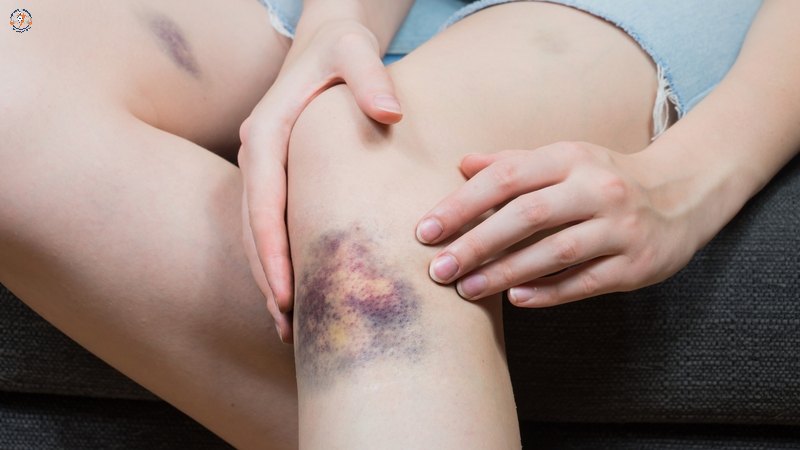 Nguyên nhân gây ra các chấn thương mô mềm